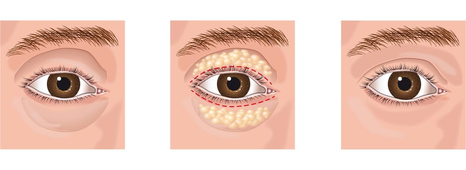 Grafik Lidstraffung Grafik Lidstraffung